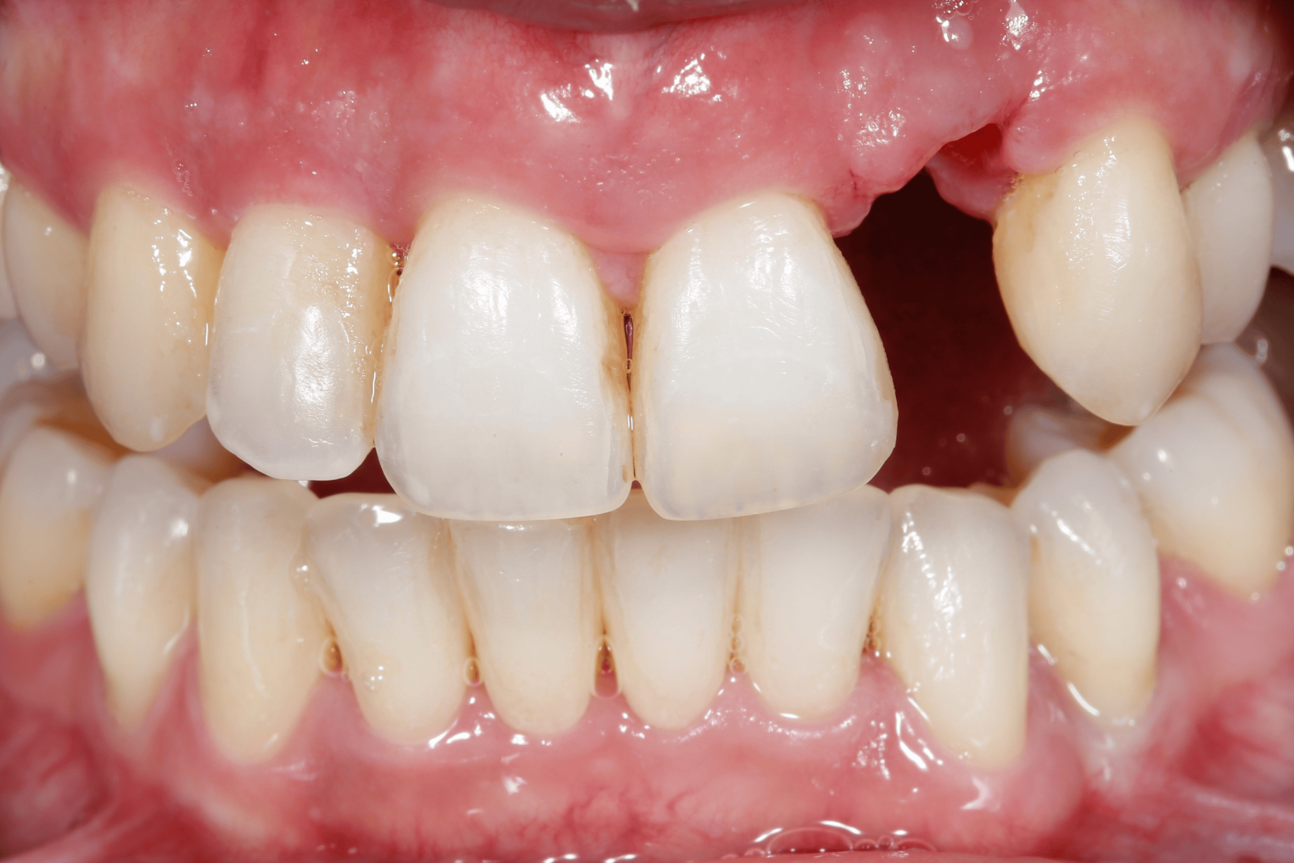 Casos reales de odontología - antes1