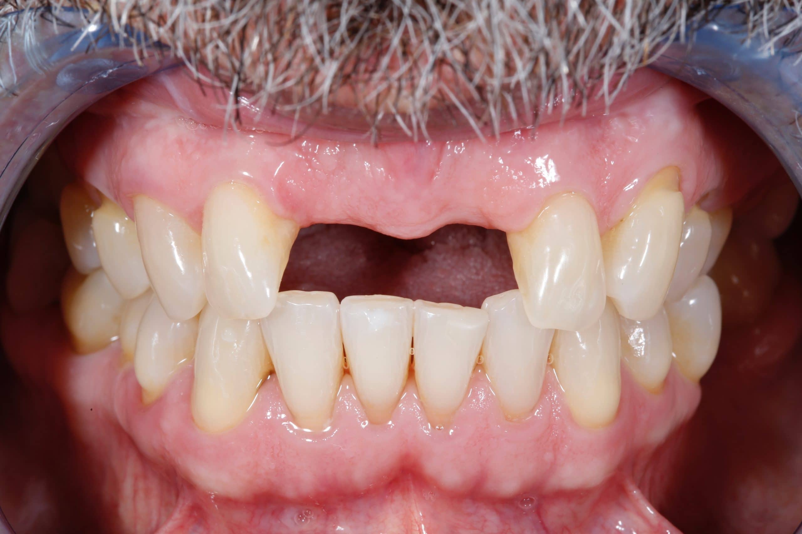 Casos reales de odontología - antes2